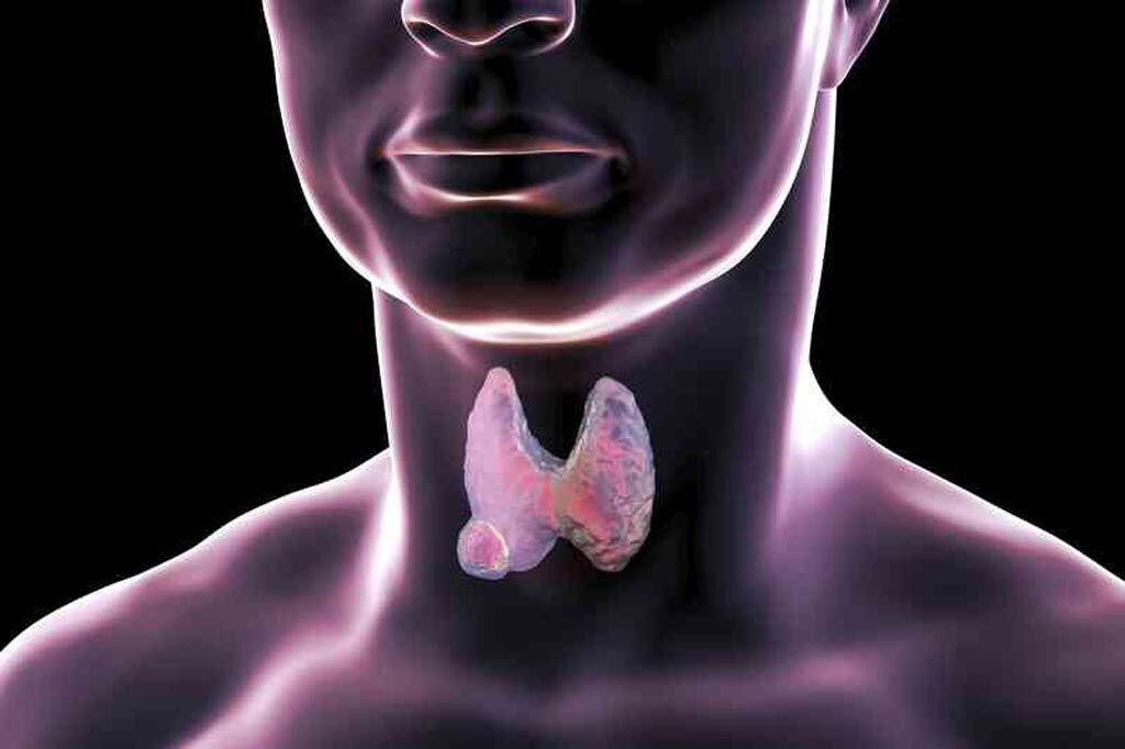 Imagen: Glándula tiroides anormal con enfermedad de Hashimoto (I) y una glándula normal (D) (Fotografía cortesía de 123rf.com).