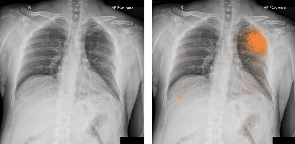 Imagen: Radiografía de tórax de un neumotórax pasado por alto por el radiólogo (I), pero identificado por el modelo de DL (D) (Fotografía cortesía de Google Health)