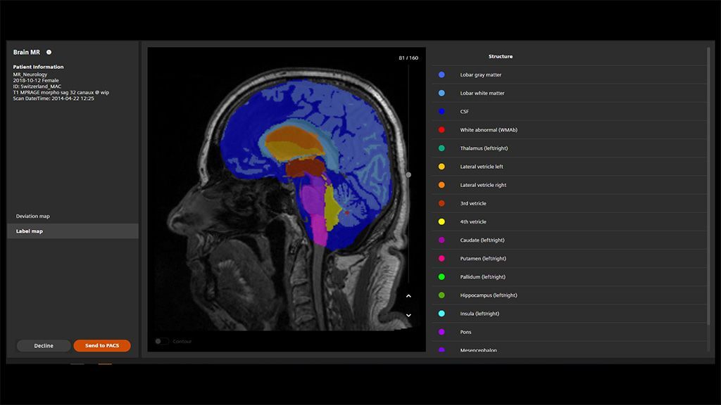 Imagen: La RM de Cerebro AI-Rad Companion para Análisis de Morfometría (Fotografía cortesía de Siemens Healthineers)