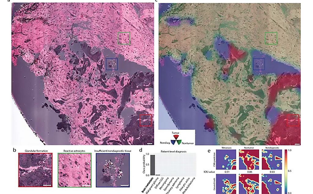 Imagen: Localización de infiltración de tumor cerebral metastásico en imágenes de SRH (Fotografía cortesía del MGH)
