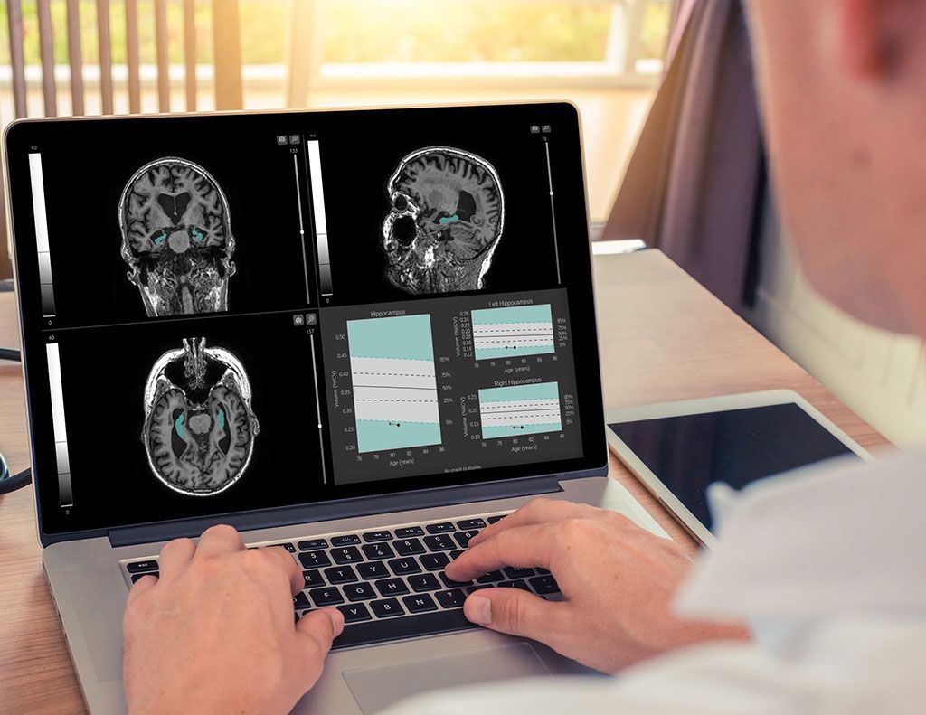 Imagen: Un software ayuda a la detección temprana de las enfermedades neurodegenerativas (Fotografía cortesía de Qynapse)