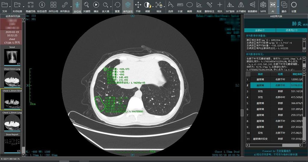 Imagen: Un sistema inteligente de lectura de imágenes genera análisis rápidos en áreas epidémicas (Fotografía cortesía de Ping An Smart Healthcare)