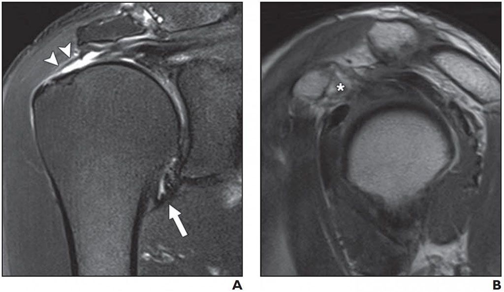 Imagen: Cápsula articular normal en el receso axilar (A); Rotura de grosor completo del tendón supraespinoso (B) (Fotografía cortesía del AJR)