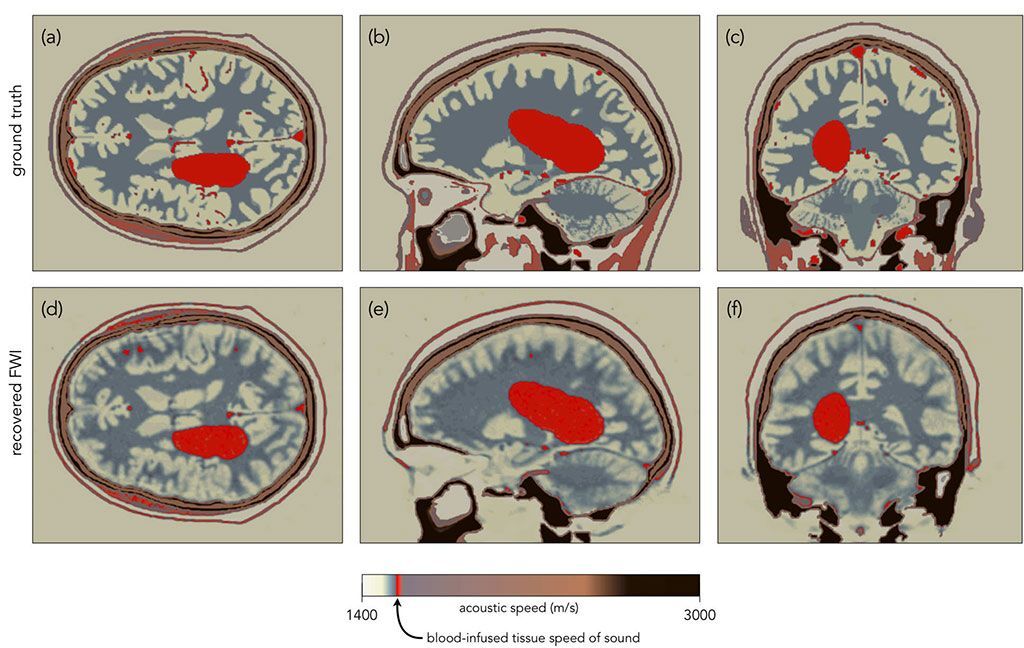 Imagen: Imágenes simuladas por computadora de la FWI detectando una hemorragia cerebral (Fotografía cortesía del Colegio Imperial de Londres)