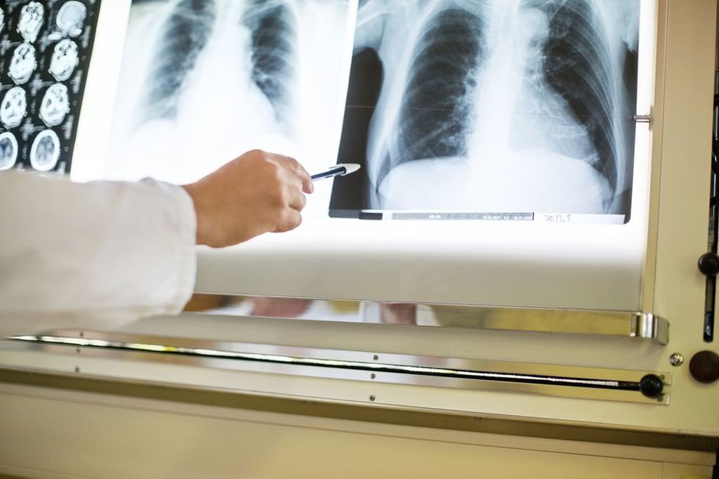 Imagen: Una radiografía de tórax normal no es suficiente para excluir la COVID-19 (Fotografía cortesía de Getty Images). Imagen: Una radiografía de tórax normal no es suficiente para excluir la COVID-19 (Fotografía cortesía de Getty Images).
