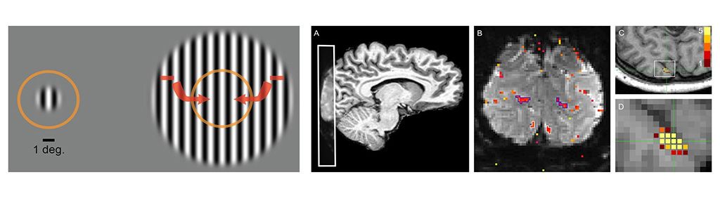 Imagen: La fMRI ayuda a revelar la supresión neuronal en el autismo (Fotografía cortesía de Michael-Paul Schallmo/UMN)