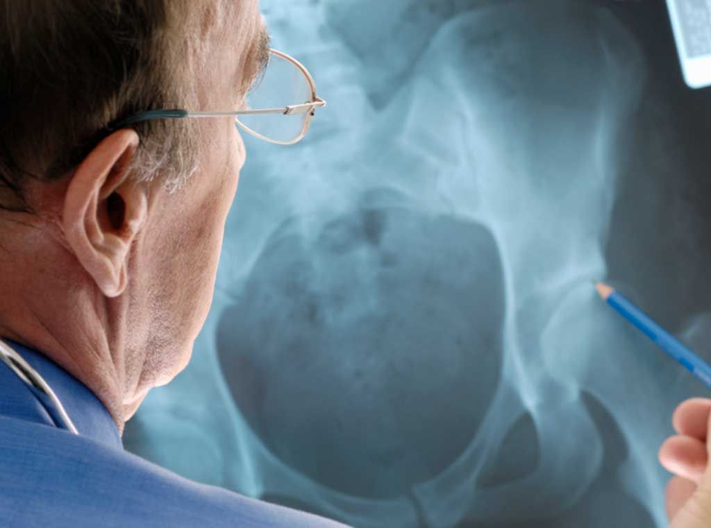 Imagen: Un algoritmo de aprendizaje profundo puede ayudar a los radiólogos a detectar fracturas de cadera (Fotografía cortesía de Getty Images) Imagen: Un algoritmo de aprendizaje profundo puede ayudar a los radiólogos a detectar fracturas de cadera (Fotografía cortesía de Getty Images)