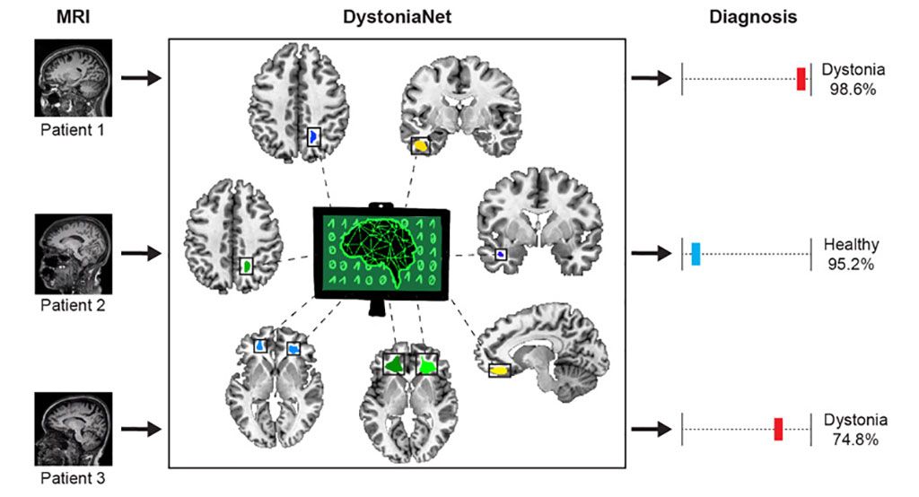 Imagen: Comparación de las imágenes de resonancia magnética procesadas por DystoniaNet (Fotografía cortesía del MEEI)