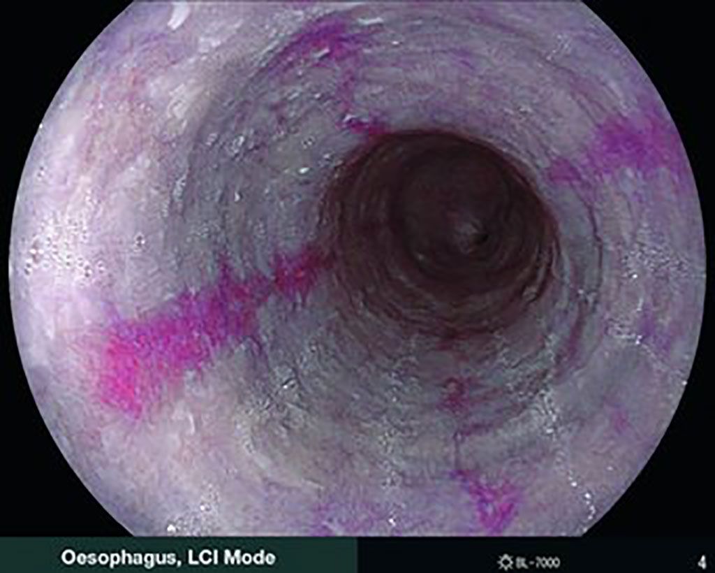 Imagen: Metaplasia intestinal identificada con la LCI (Fotografía cortesía de Fujifilm)
