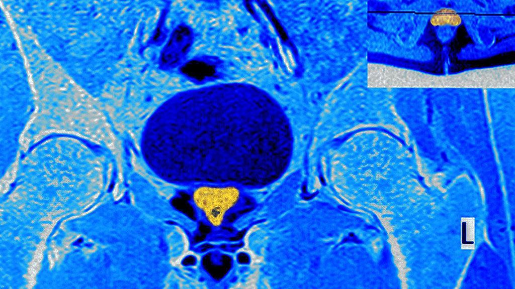 Imagen: Las imágenes de mpRM miden el tamaño del tumor de próstata como más pequeño que el verdadero (Fotografía cortesía de Alamy)