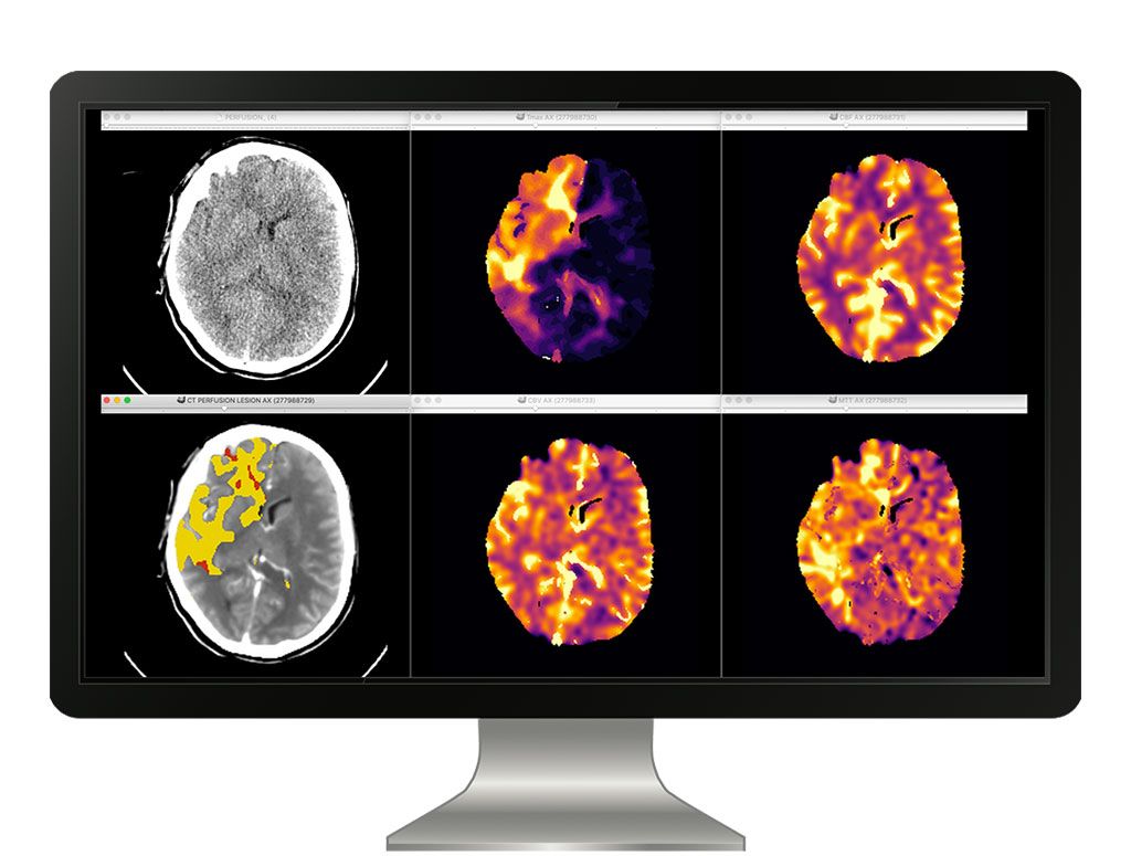 Imagen: Una plataforma totalmente automatizada evalúa el estado de la perfusión cerebrovascular (Fotografía cortesía de icometrix)