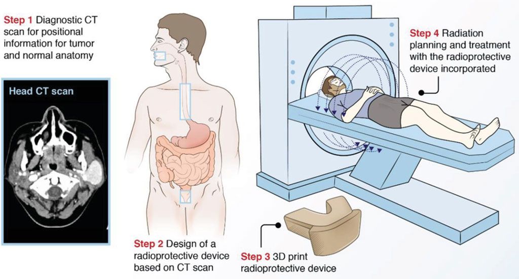 Imagen: Flujo de trabajo clínico para la integración de dispositivos radioprotectores personalizados en la RT (Fotografía cortesía de BWH)