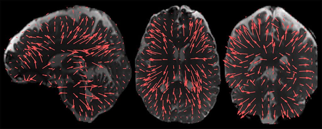 Imagen: Patrones de desplazamiento cerebral habilitados por el procesamiento adicional de la aMRI 3D (Fotografía cortesía de Mātai)