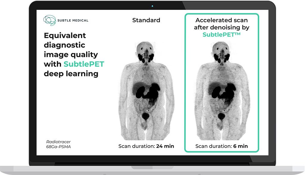 Imagen: Calidad de imagen de diagnóstico equivalente del software SubtlePET (Fotografía cortesía de Subtle Medical)