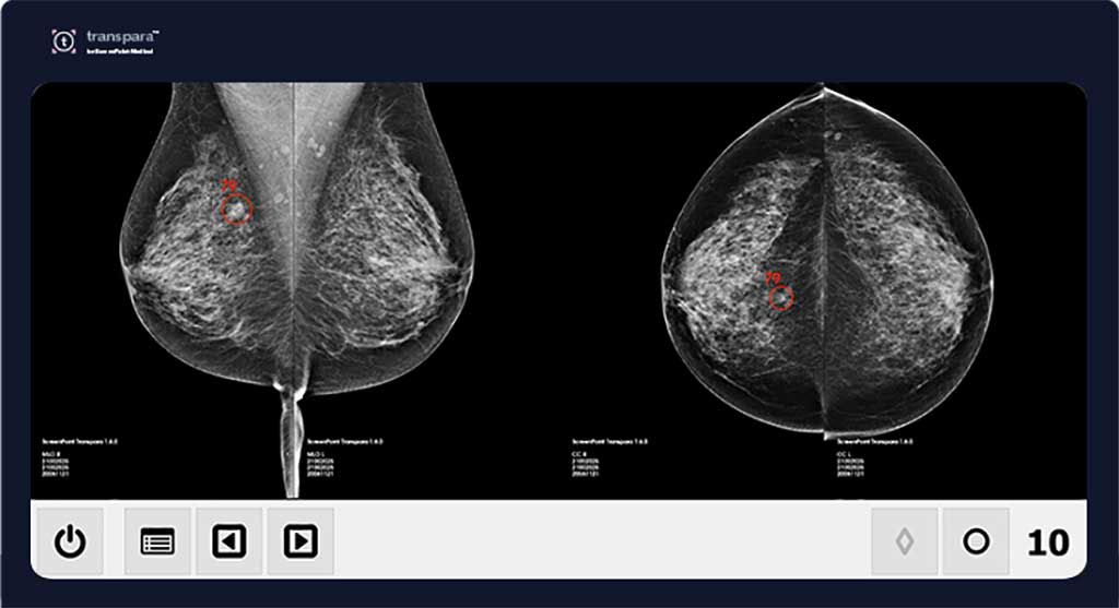 Imagen: Transpara AI puede reducir la carga de trabajo de las mamografías (Fotografía cortesía de ScreenPoint Medical)