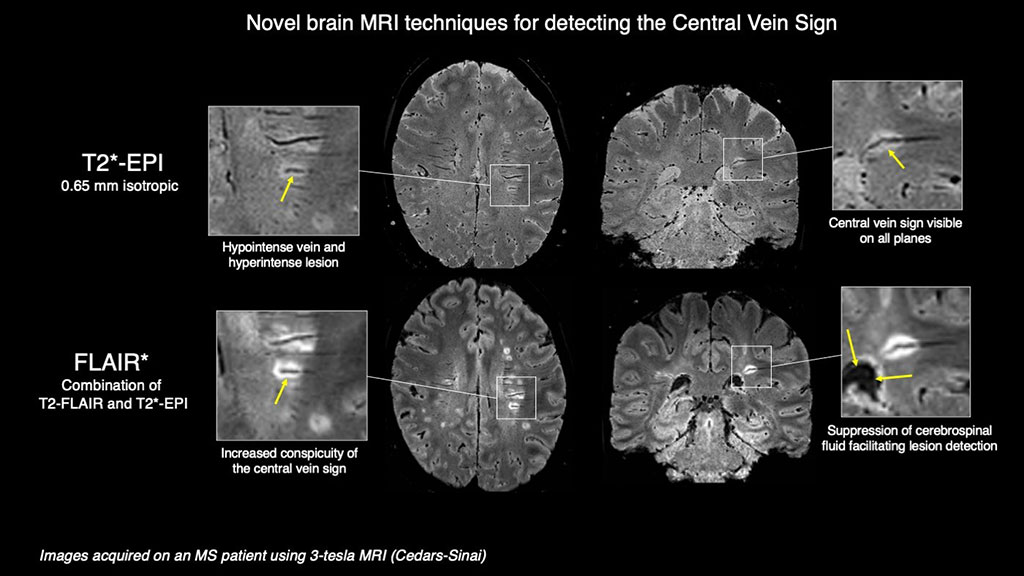 Imagen: Imágenes muestran nuevas técnicas de resonancias magnéticas cerebrales para detectar el signo de la vena central (Fotografía cortesía de Cedars-Sinai)