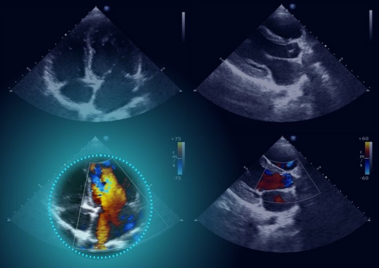 Imagen: La aplicación para análisis de imágenes cardiacas Echo: Prio ha recibido autorización de la FDA (Fotografía cortesía de Dyad Medical)