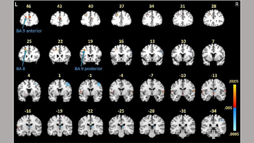 Imagen: Los escaneos cerebrales indican altos niveles de activación de materia blanca en los lóbulos frontales de los participantes con enfermedad de Lyme posterior al tratamiento (Fotografía cortesía de Johns Hopkins Medicine)