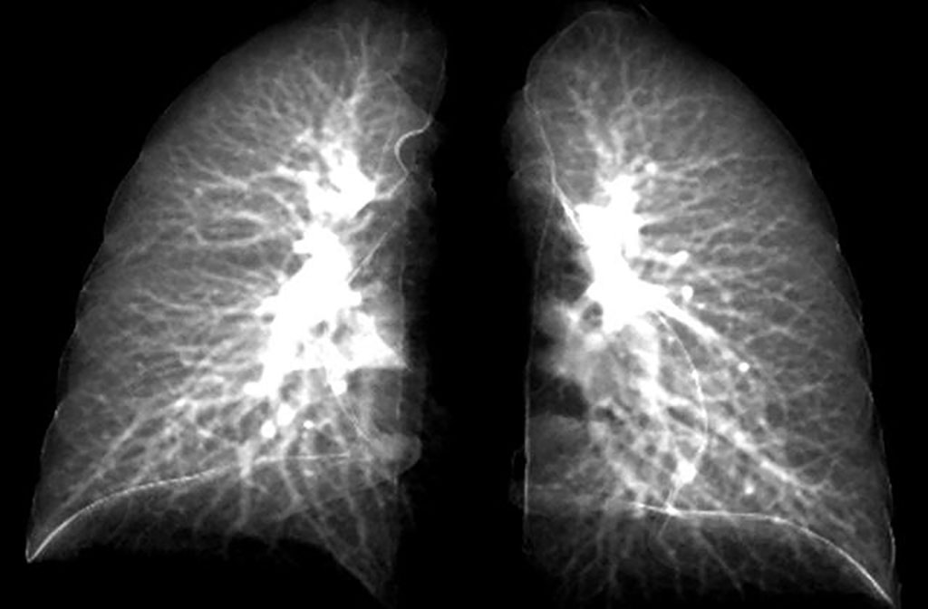 Imagen: El modelo avanzado puede detectar daño pulmonar en pacientes con COVID prolongada y clasificar los subtipos de pacientes (Fotografía cortesía de la Universidad de Iowa)