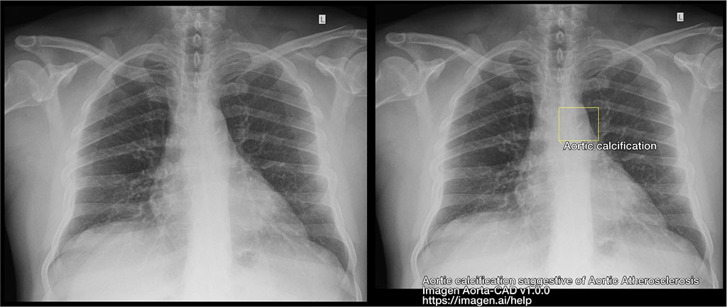 Imagen: La izquierda muestra la radiografía de tórax. El derecho muestra el resultado de Aorta-CAD en la misma radiografía de tórax (Fotografía cortesía de Imagen)