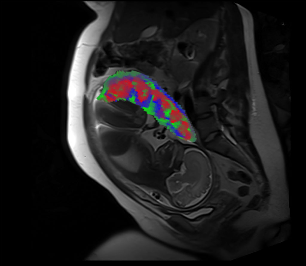 Imagen: Imagen de resonancia magnética que muestra el feto y los compartimentos placentarios (Fotografía cortesía de WUSTL)