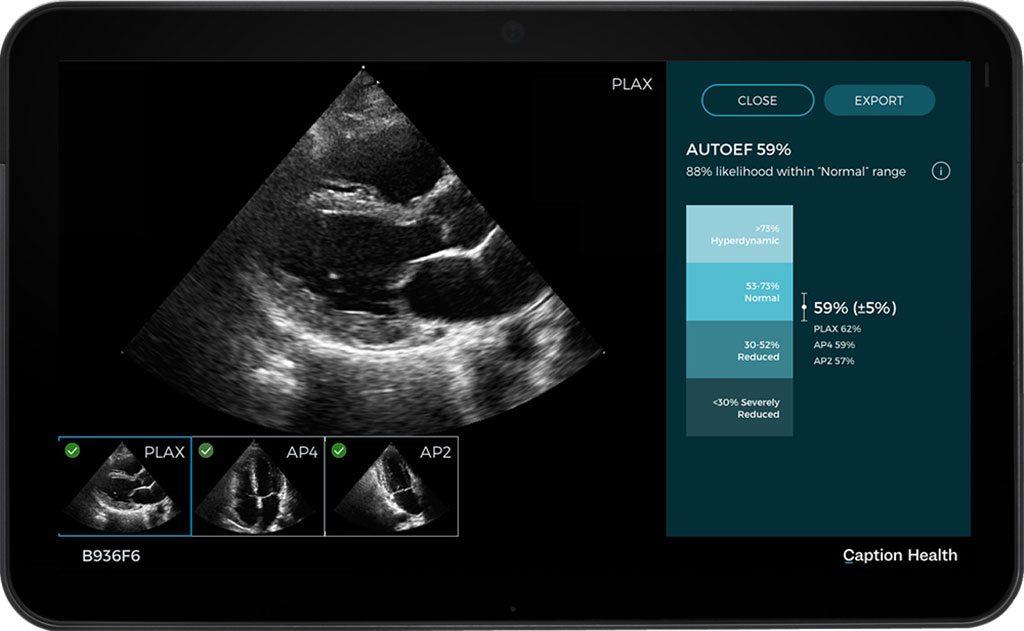 Imagen: La plataforma de IA de Caption permite a cualquier profesional de la salud capturar imágenes de ultrasonido de calidad diagnóstica (Fotografía cortesía de Caption Health)