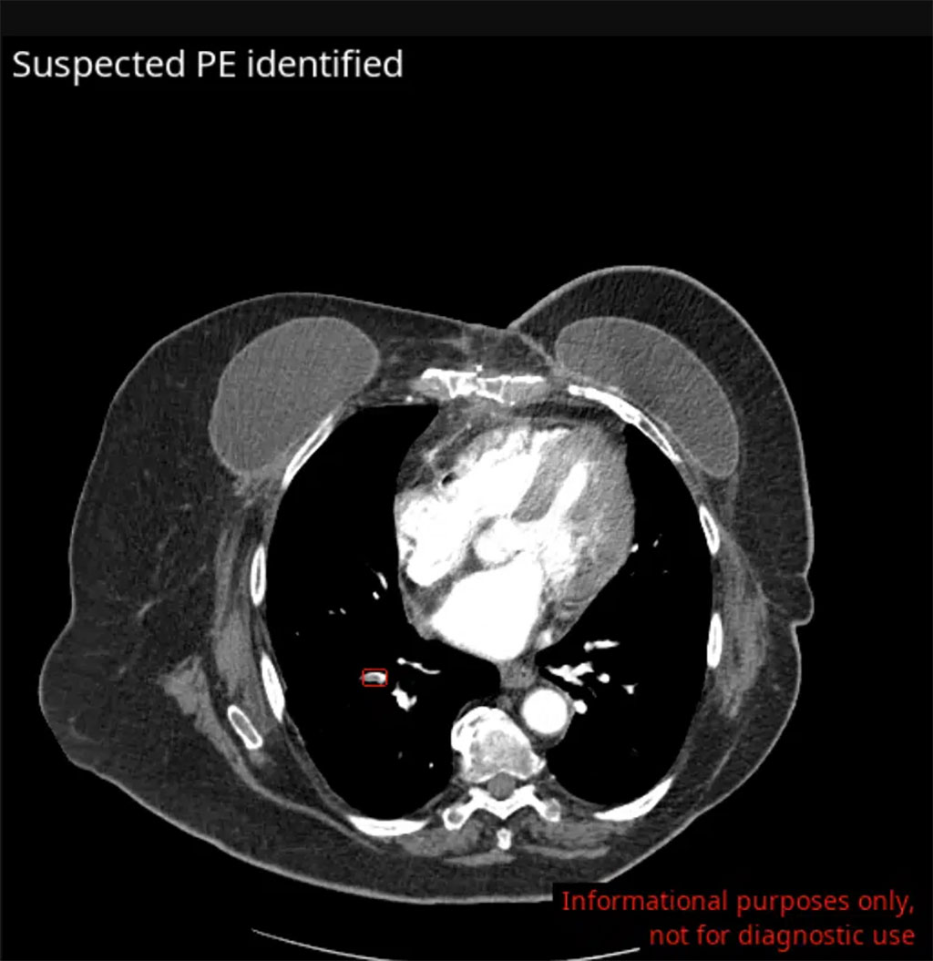 Imagen: La nueva solución de IA detecta la embolia pulmonar incidental de las tomografías computarizadas del pecho (Fotografía cortesía de Avicenna)