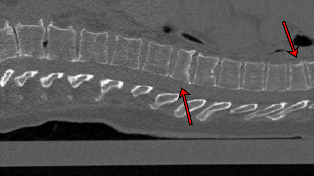 Imagen: Imagen seccional 2D de TC que muestra dos fracturas correctamente clasificadas por IA (Fotografía cortesía de la Universidad de Kiel)