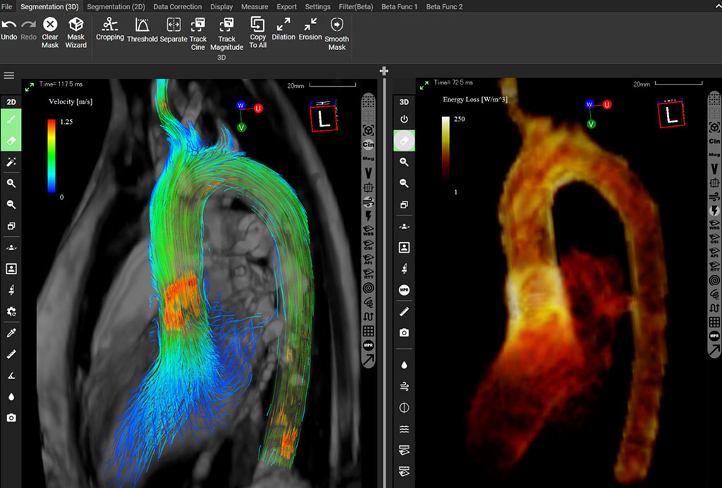 Imagen: La solución de software iTFlow ha recibido la aprobación de la FDA de EUA (Fotografía cortesía de Cardio Flow Design)