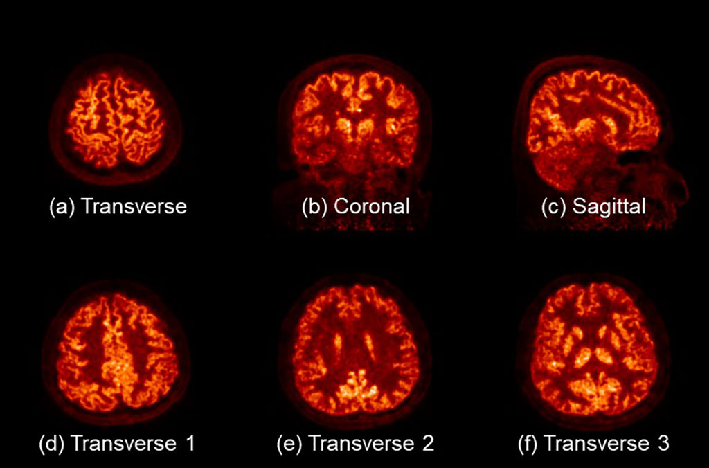 Imagen: Imágenes de un cerebro humano inyectado con 18F-FDG obtenido con SIAT bPET (Fotografía cortesía de SIAT)