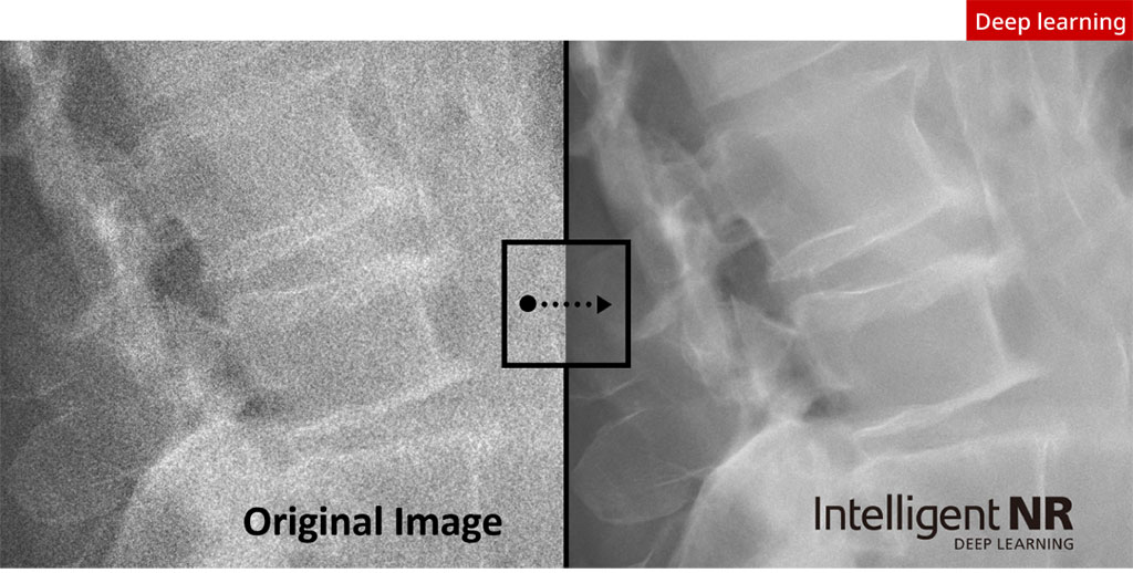 Imagen: Red neuronal inteligente proporciona imágenes de diagnóstico de alta calidad que contienen ruido significativamente menos granulado (Fotografía cortesía de Canon)