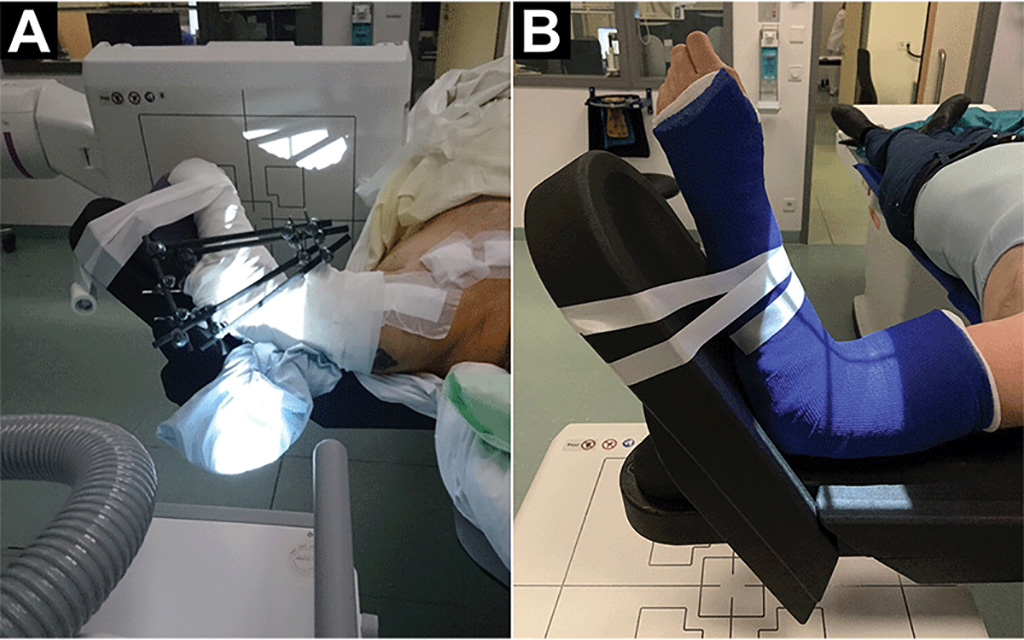 Imagen: Las fotografías muestran pacientes con rango de movimiento severamente limitado (Fotografía cortesía del Hospital Universitario de Würzburg)