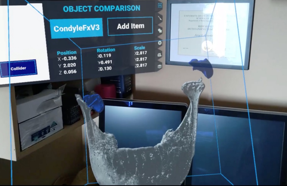 Imagen: Los hologramas 3D de alta fidelidad específicos del del paciente del software de RA permiten a los cirujanos comprender mejor la anatomía complicada (Fotografía cortesía de Sira Medical)