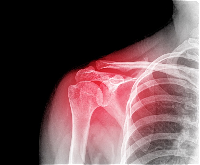 Imagen: el aprendizaje profundo permite decisiones más rápidas y precisas sobre el tratamiento de anormalidades de los hombros (foto cortesía de 123RF)