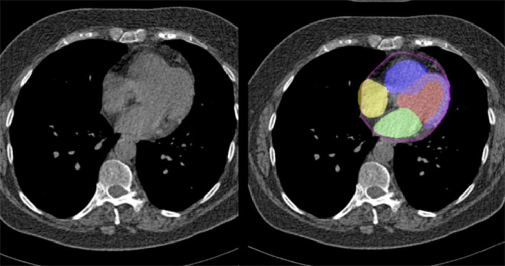 Imagen: la IA puede identificar el riesgo cardiovascular integral de las tomografías computarizadas obtenidas sin tinte de contraste (foto cortesía de Cedars-sinai)