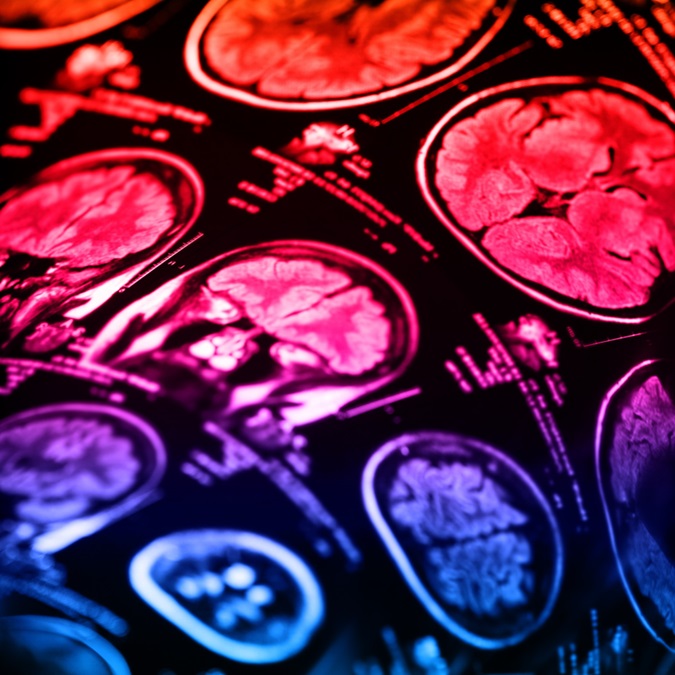 Imagen: los escaneos PET revelan inflamación en pacientes con esclerosis múltiple