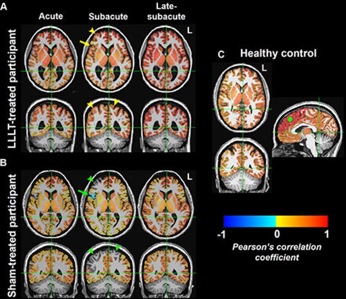 Imagen: Mapas cerebrales de fMRI de la conectividad funcional en estado de reposo en participantes representativos de la misma edad y sexo (foto cortesía de Radiology; doi.org/10.1148/radiol.230999)
