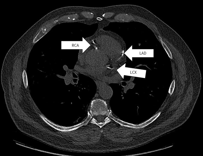 Imagen transaxial de una tomografía computarizada de detección de cáncer de pulmón que muestra calcio en las tres arterias coronarias (foto cortesía de CMaj doi/10.1503/cmaj.231602)