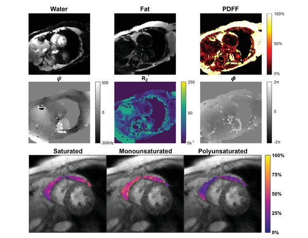 Imágenes de un corte de eje corto del ventrículo medio tomadas de un paciente representativo con STEMI (foto cortesía de Magnetic Resonance in Medicine, doi.org/10.1002/mrm.30285)