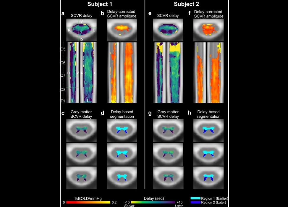 Imagen: Mapas de la reactividad vascular de la médula espinal mediante resonancia magnética funcional en dos individuos (Foto cortesía de Molly Bright, DPhil)