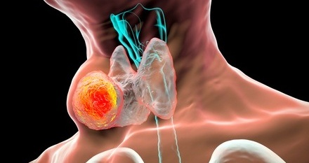 Imagen: el análisis de TC impulsado por IA ayuda a identificar pacientes con cáncer de orofaringe que pueden necesitar un tratamiento más o menos agresivo (Fotografía cortesía de Shutterstock)