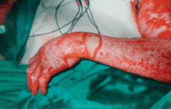 Image: A case study of treatment with Nexobrid after a 4-hour application (Photo courtesy of MediWound).