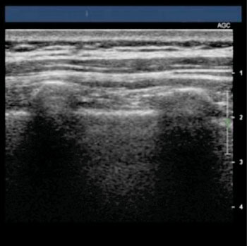 Image: Ultrasound image of a lung (Photo courtesy of JP Rathmell). Image: Ultrasound image of a lung (Photo courtesy of JP Rathmell).