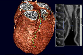 Image: A computed tomography (CT) scan of a healthy heart shows the coronary artery running down the front. A scan showing calcium buildup in the artery could trigger treatment (Photo courtesy of Vassilios Raptopoulo). Image: A computed tomography (CT) scan of a healthy heart shows the coronary artery running down the front. A scan showing calcium buildup in the artery could trigger treatment (Photo courtesy of Vassilios Raptopoulo).