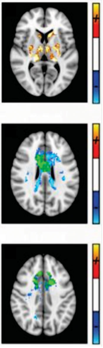 Image: Dr. Ravi Menon, an imaging scientist at Western University’s Robarts Research Institute, used quantitative susceptibility MRI to show and measure damage in specific areas of the brain, which the study showed to be common to all MS and clinically isolated syndrome (CIS) patients (Photo courtesy of Western University).