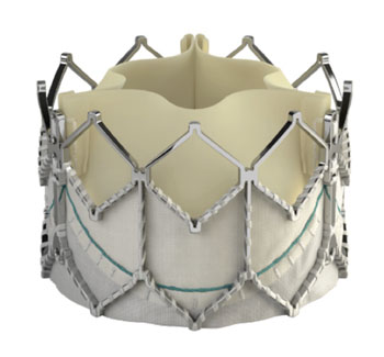 Image: The Edwards SAPIEN XT transcatheter heart valve (Photo courtesy of Edwards Lifesciences).