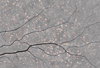 Image: Amyloid plaques showing up in retinal scan as fluorescent spots as curcumin binds to them (Photo courtesy of CSIRO). Image: Amyloid plaques showing up in retinal scan as fluorescent spots as curcumin binds to them (Photo courtesy of CSIRO).