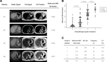 Image: Multi-echo MRI fat fractions positively correlate with the grade of steatosis estimated by histopathologic measurements. (A) Representative multi-echo MRI images showing different degrees of water and fat intensity, and fat fraction in different patients. (B) Multi-echo MRI fat fractions positively correlate with the grade of steatosis estimated by histopathologic measurements in human livers (n =129). Dots represent the values of each case. (C) Multi-echo MRI fat fraction mean values of each steatosis grading group (0 to 3 scale). CV, coefficient of variation; MRI, magnetic resonance imaging; Std. Dev, standard deviation (Photo courtesy of Jiménez-Agüero, et al: BMC Medicine 2014 12:137). Image: Multi-echo MRI fat fractions positively correlate with the grade of steatosis estimated by histopathologic measurements. (A) Representative multi-echo MRI images showing different degrees of water and fat intensity, and fat fraction in different patients. (B) Multi-echo MRI fat fractions positively correlate with the grade of steatosis estimated by histopathologic measurements in human livers (n =129). Dots represent the values of each case. (C) Multi-echo MRI fat fraction mean values of each steatosis grading group (0 to 3 scale). CV, coefficient of variation; MRI, magnetic resonance imaging; Std. Dev, standard deviation (Photo courtesy of Jiménez-Agüero, et al: BMC Medicine 2014 12:137).
