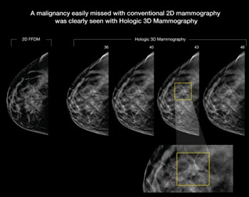 Image: A tumor that easily missed on 2-D mammography was clearly seen on 3-D mammography (Photo courtesy of RSNA). Image: A tumor that easily missed on 2-D mammography was clearly seen on 3-D mammography (Photo courtesy of RSNA).