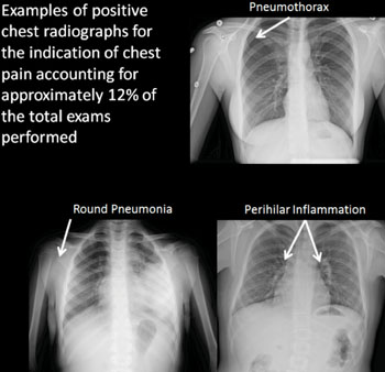 Image: Examples (pneumothorax, round pneumonia, perihilar inflammation) of positive chest radiographs for the indication of chest pain, accounting for approximately 12% of total exams performed (Photo courtesy of RSNA). Image: Examples (pneumothorax, round pneumonia, perihilar inflammation) of positive chest radiographs for the indication of chest pain, accounting for approximately 12% of total exams performed (Photo courtesy of RSNA).